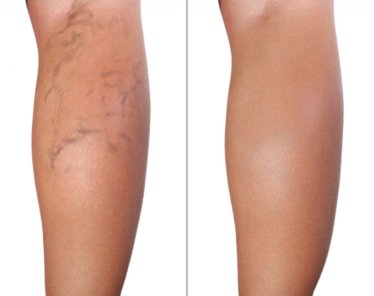 A before and after picture of varicose veins on the legs.