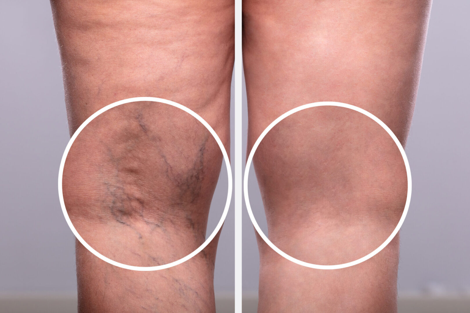 Two pictures of a person with varicose veins.