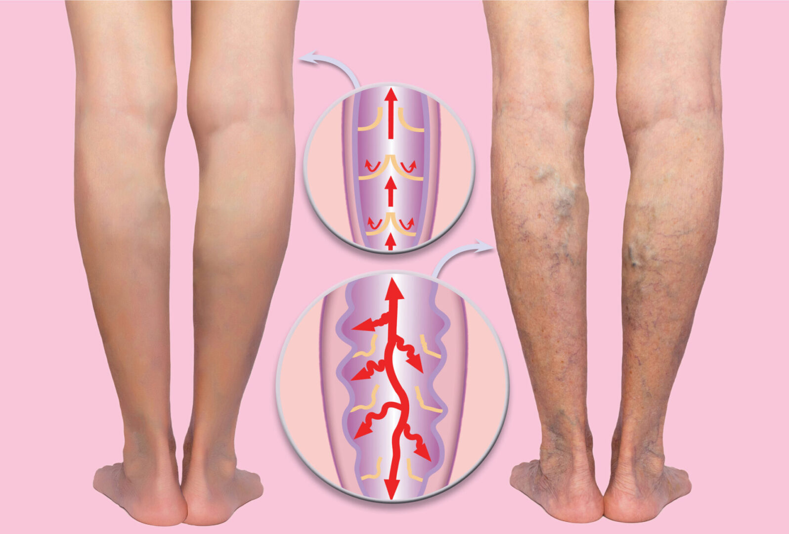 A man with varicose veins on his legs.