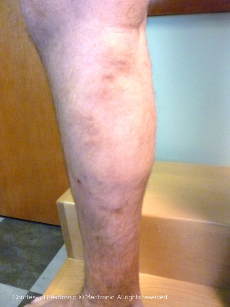 A person with some type of skin disease on their leg.