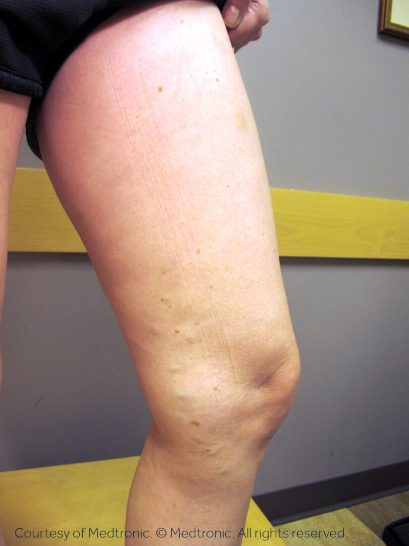 A person with varicose veins on their legs.